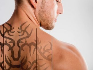 Remoção de tatuagem tattoo laser - Homem No Espelho
