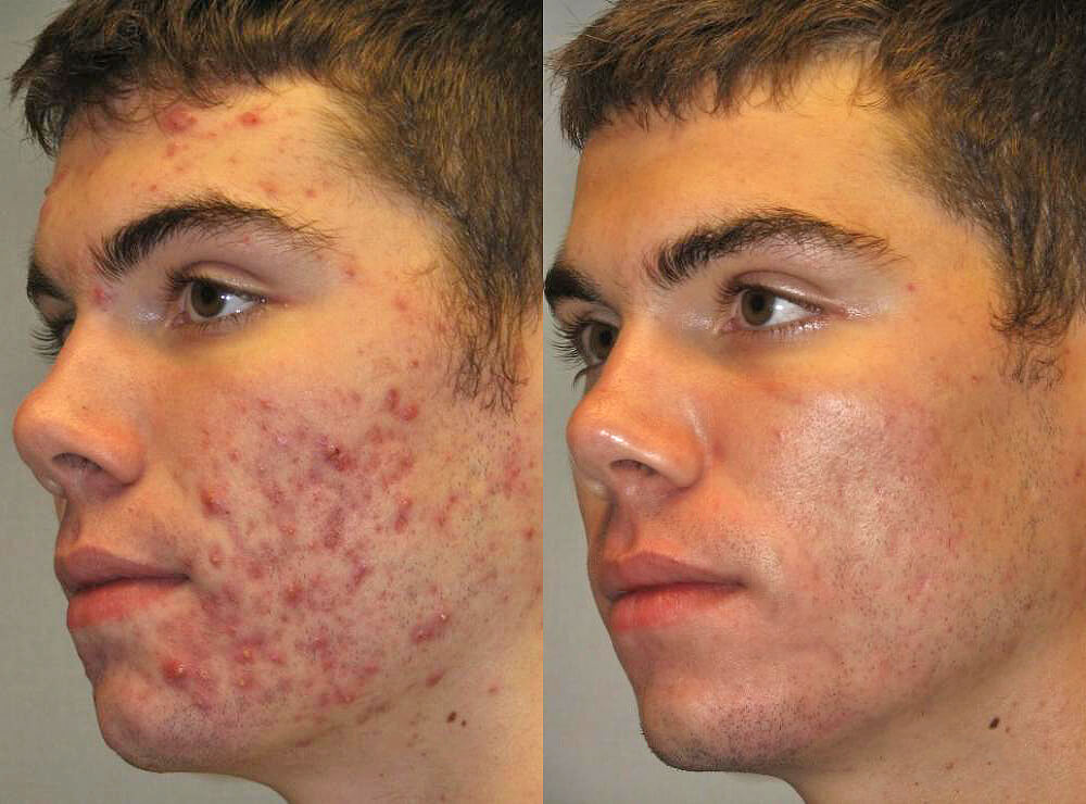 Homem No Espelho - Laser no tratamento de acne